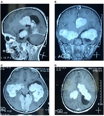 Intracranial Rosai Dorfman Disease Presented With Multiple Huge Intraventricular Masses: A Case Report